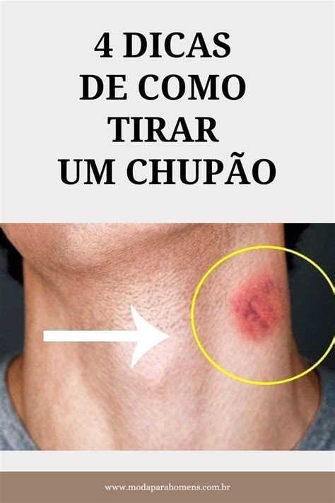 como tirsr chupao|15 truques fáceis de como tirar chupão do pescoço